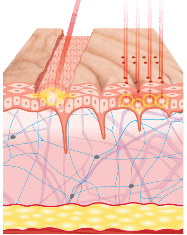 Diagram showing how YAG laser works