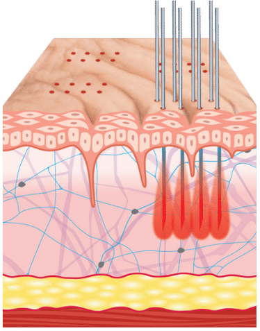 Diagram showing microneedling into skin