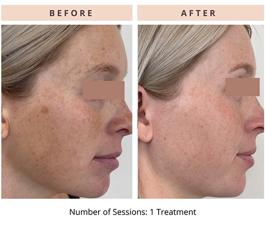CoolPeel Results