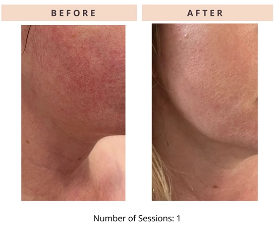 CoolPeel Results