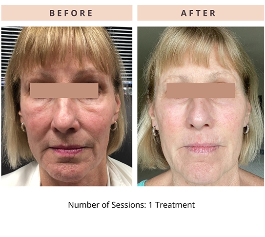 CoolPeel Results