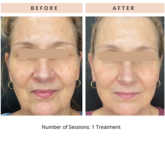 CoolPeel Results