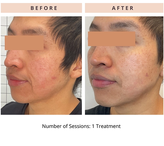 CoolPeel Results