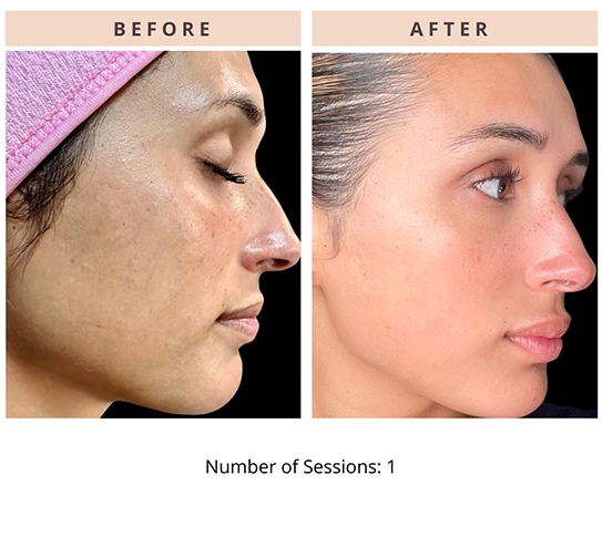 CoolPeel Results