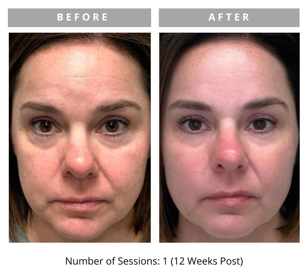 Radiant Lift Results