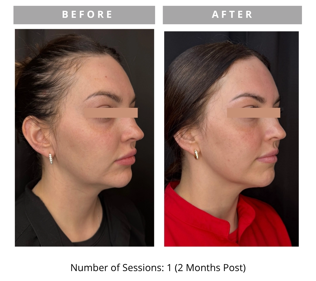 Radiant Lift Results