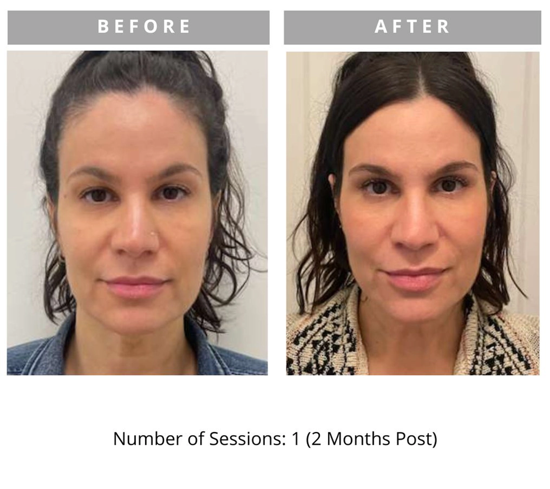 Radiant Lift Results