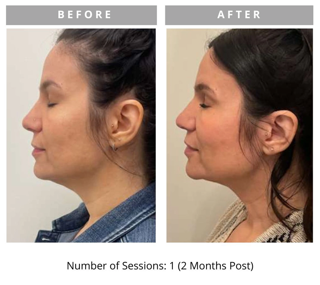 Radiant Lift Results