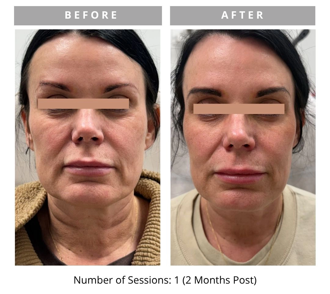 Radiant Lift Results